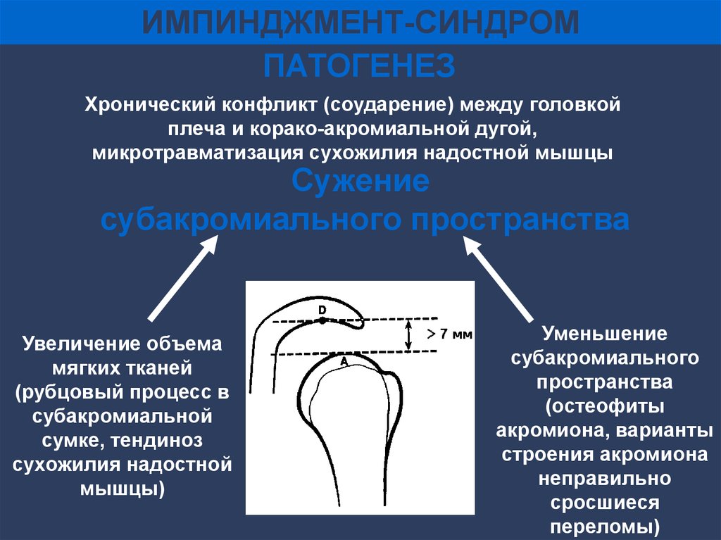 Нормативное пространство. Подакромиальный импинджмент. Субакромиальный импичмент синдром плечевого сустава. Подакромиальный импиджмент синдром. Подакромиальный импинджмент синдром плечевого сустава.