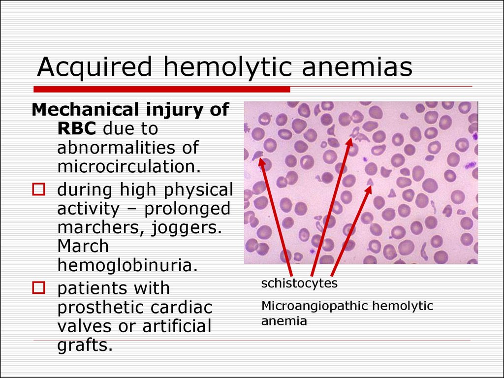 Acquired hemolytic anemias