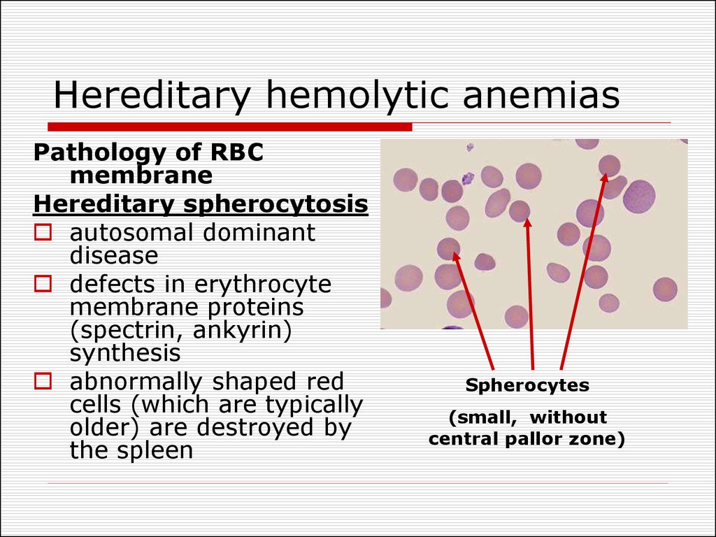 Hereditary hemolytic anemias