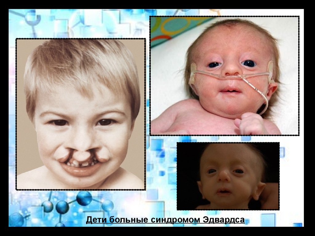 Синдром эдвардса фото детей