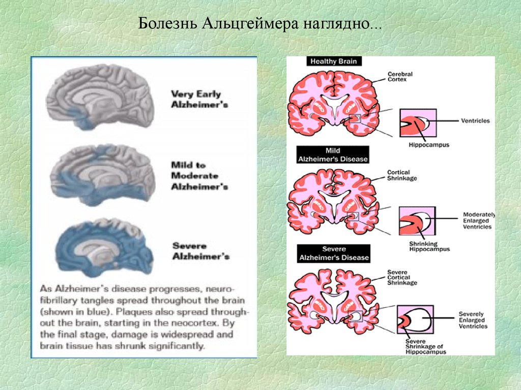 Причины болезни альцгеймера. Болезнь Альцгеймера локализация поражения. Синдром Альцгеймера. Локализация поражения при болезни Альцгеймера. Мозг человека с болезнью Альцгеймера.