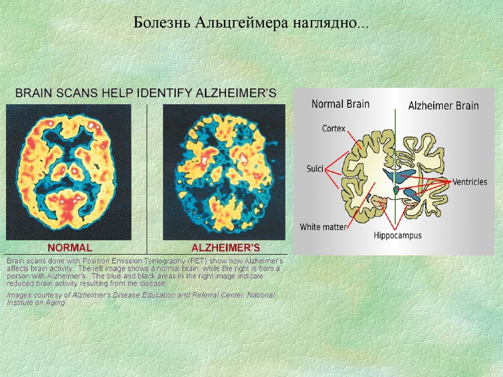 Причины болезни альцгеймера. Болезнь Альцгеймера. Мозг здоровый и Альцгеймера. Мозг человека при Альцгеймера. Тяжелая форма Альцгеймера.
