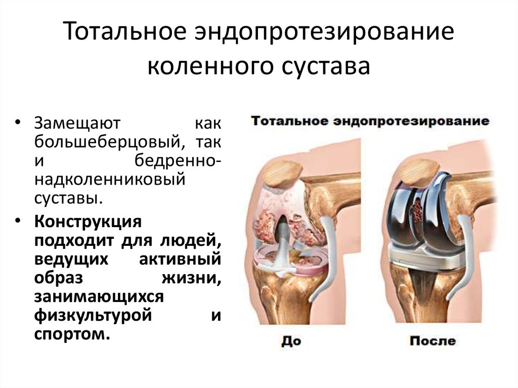 Инвалидность после эндопротезирования. Компоненты эндопротеза коленного сустава. Артроз коленного сустава эндопротез. Эндопротез коленного сустава протокол операции. Эндопротез коленного сустава.