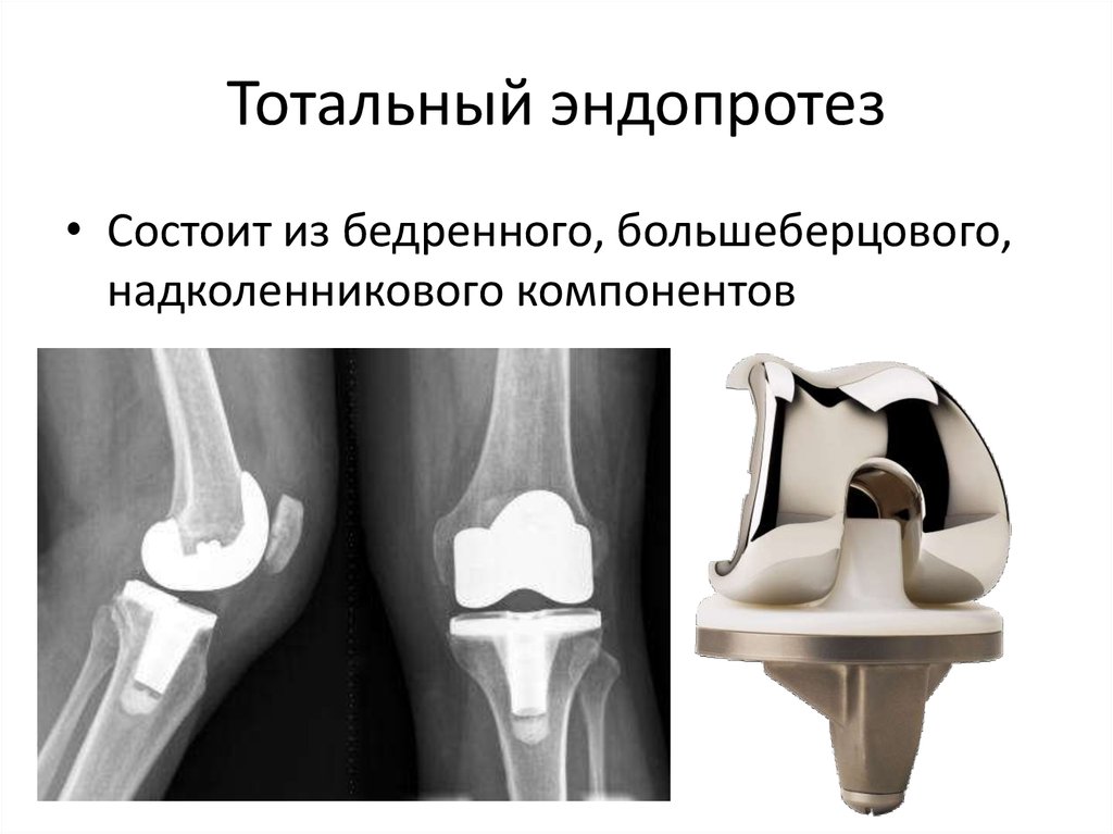 Эндопротезирование коленного сустава клиника. Тотальное эндопротезирование коленного сустава рентген. Эндопротез коленного сустава рентген. Модульный эндопротез коленного сустава цито. Эндопротезирование коленногоо СУСТАВАРЕНТГЕН.
