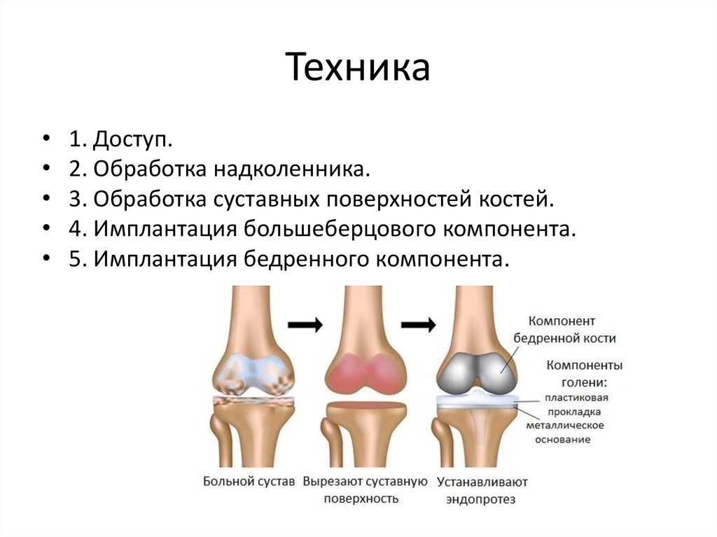 Полное расхождение суставных костей относительно друг. Феморальный компонент эндопротеза коленного сустава. Уплотнение суставных поверхностей большеберцовых костей. Тибиальный компонент эндопротеза коленного сустава. Суставная поверхность костей.