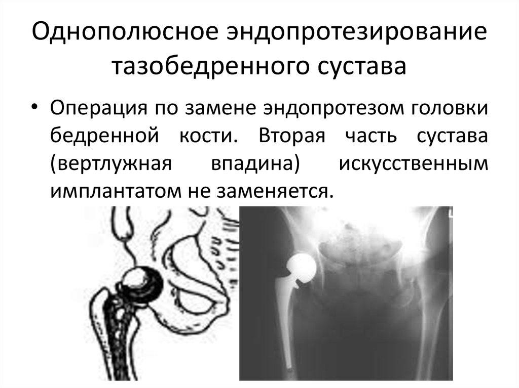 Суть операции эндопротезирования