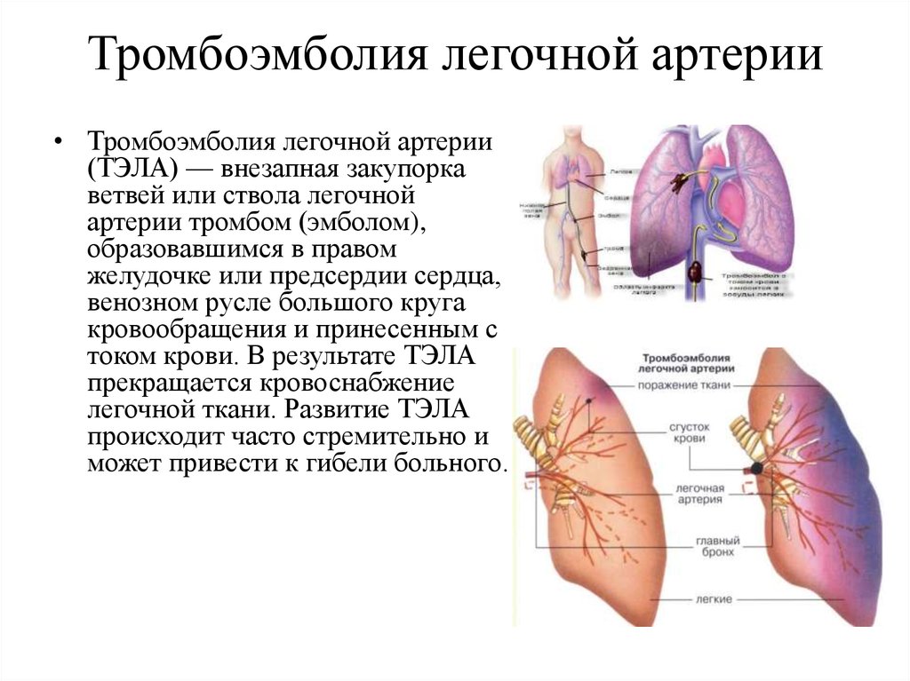 Тромбофлебит легких. Тромбоэмболия легочной артерии причины развития. Тромбоэмболия крупных ветвей легочной артерии. Тромбоз лёгочной артерии симптомы. Локализация тромбов при тромбоэмболии легочной артерии.