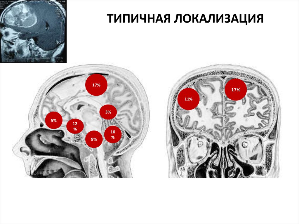Виды опухолей головного. Локализация опухолей головного мозга. Локализация менингиом головного мозга. Типичные локализации менингиом. Опухоль головного мозга симптомы.