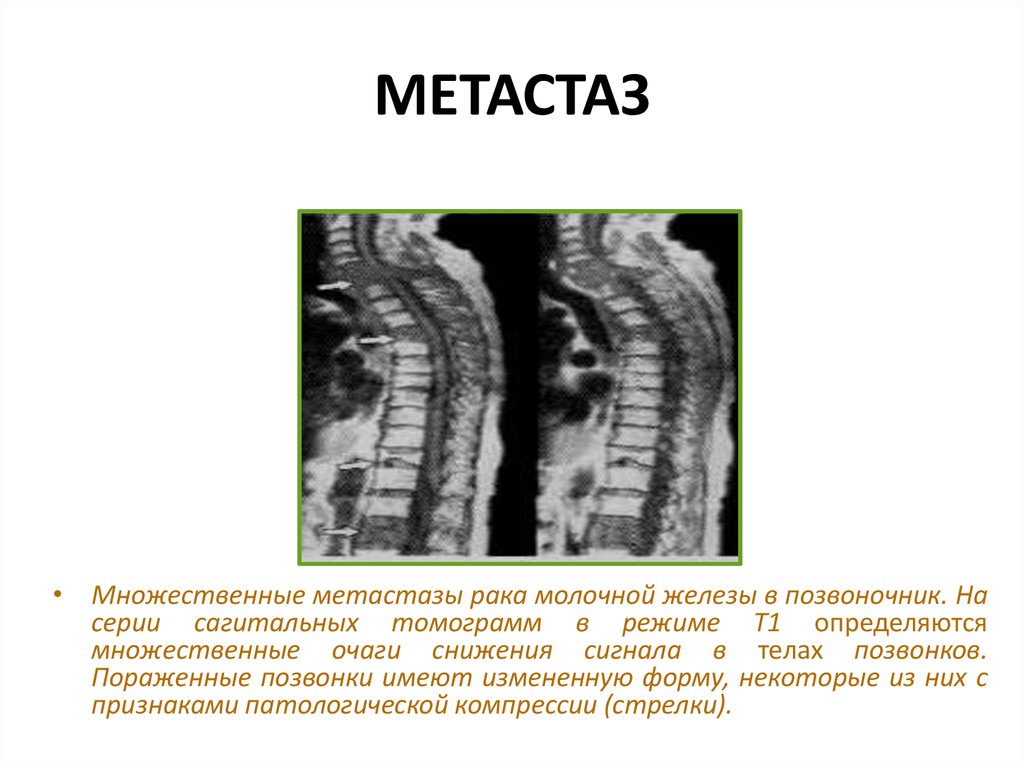 Рак молочной железы метастазы лечение. Метастазы поражения позвонков. Метастазы в тела позвонков кт. Химиоэмболизация метастаз позвоночника.