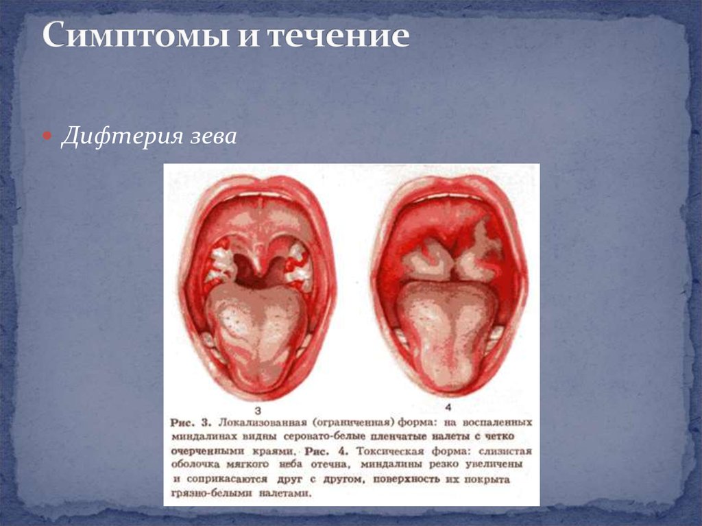Дифтерия. Этиология. Формы дифтерии - презентация онлайн
