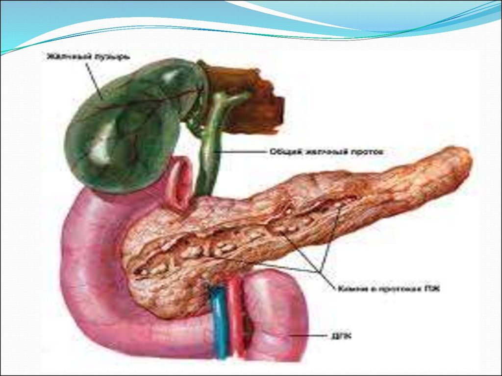 Давит поджелудочная. Хронический панкреатит поджелудочная железа. Хронический калькулезный панкреатит. Гигантский желчный пузырь.