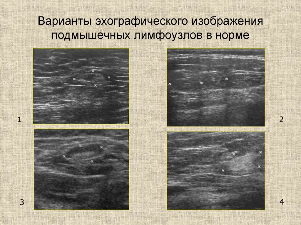 Паховые лимфоузлы размеры в норме. УЗИ лимфатических узлов норма. УЗИ анатомия лимфатических узлов. УЗИ поверхностных лимфатических узлов .. Лимфоузел на УЗИ норма.