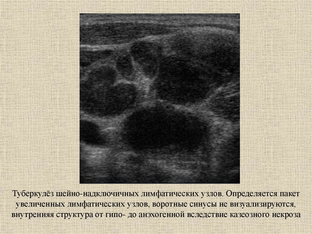 Узи периферических лимфоузлов