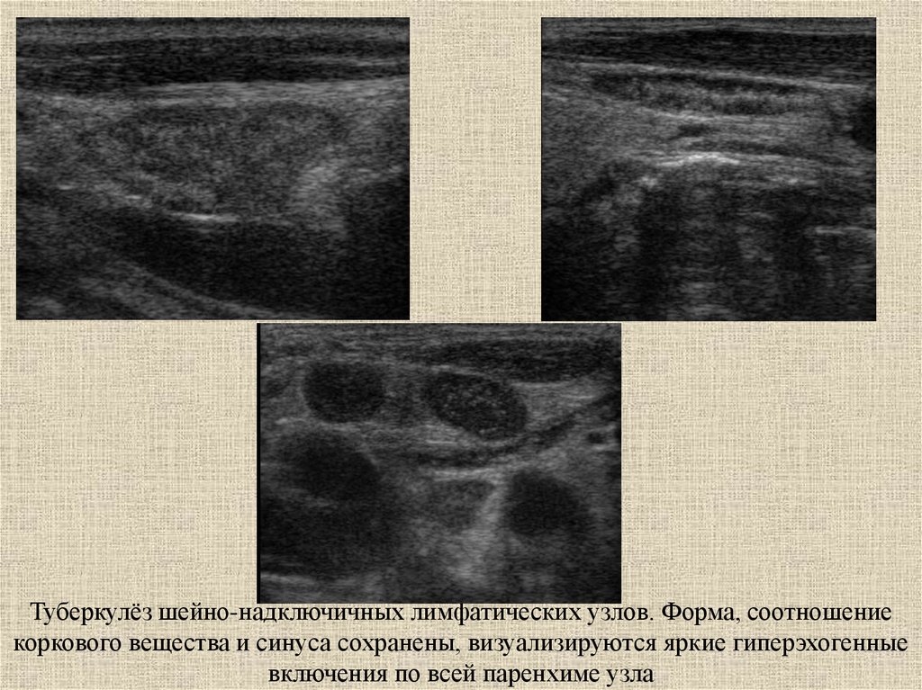 Узи лимфатических. Туберкулез лимфоузлов УЗИ. УЗИ надключичных лимфоузлов. УЗИ надключичных узлов. Надключичные лимфоузлы на УЗИ.