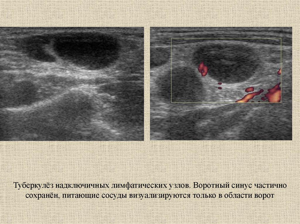 Узи периферических лимфоузлов