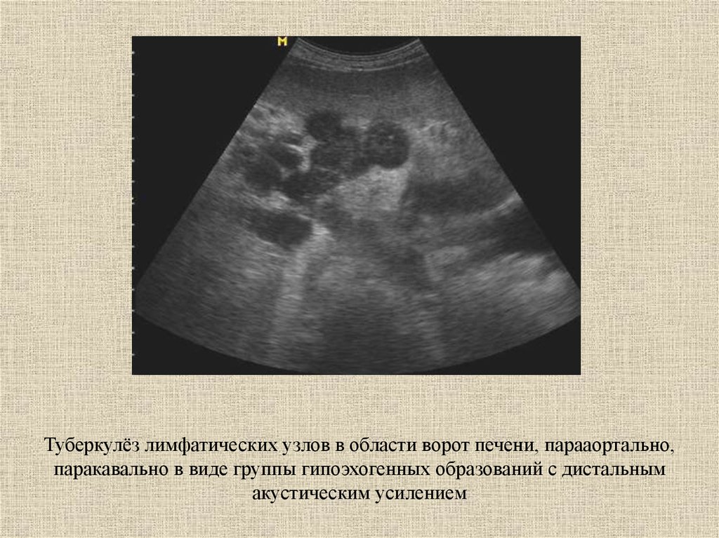 Увеличена полость. Мезентериальные лимфатические узлы в брюшной полости УЗИ. УЗИ парааортальных лимфатических узлов. Лимфаденопатия ворот печени УЗИ. Лимфоузлы в воротах печени на УЗИ.