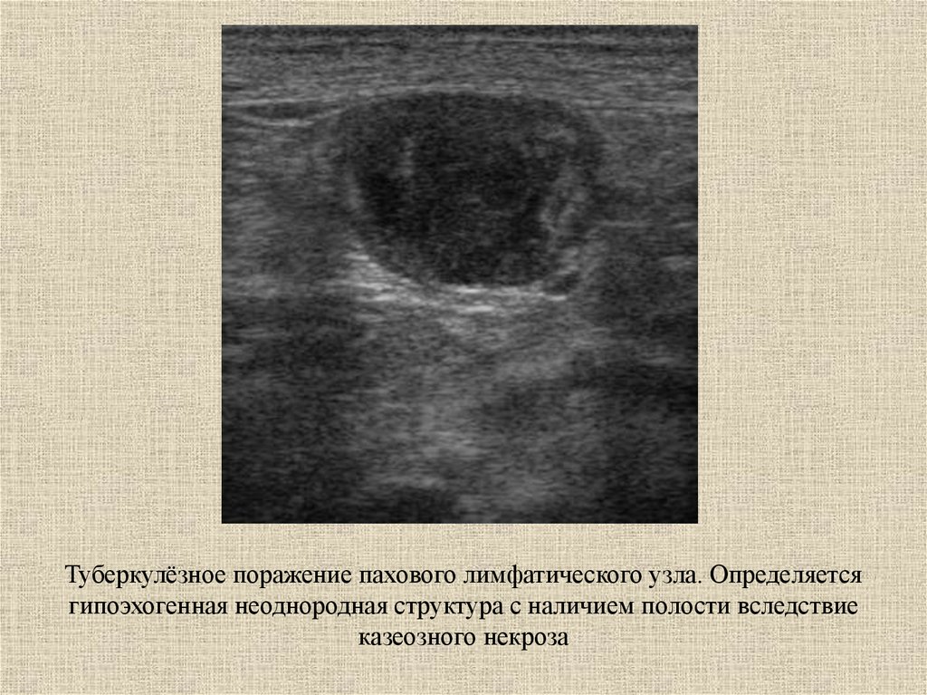 Паховые лимфоузлы. Паховые лимфатические узлы УЗИ норма. Паховые лимфатические узлы на УЗИ. Абсцесс лимфатического узла УЗИ. Туберкулезный лимфаденит на УЗИ.