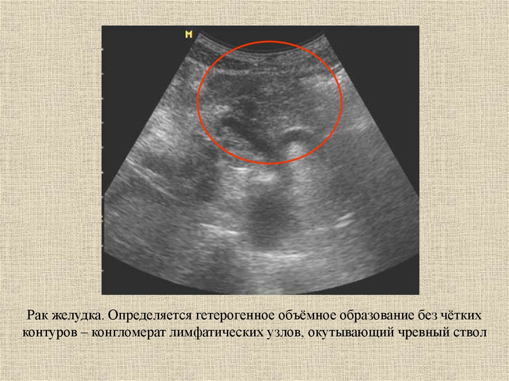 Конгломерат узлов. Гетерогенное образование. Гетерогенное образование что это в УЗИ. Конгломерат лимфоузлов на УЗИ. Конгломерат лимфатических узлов.