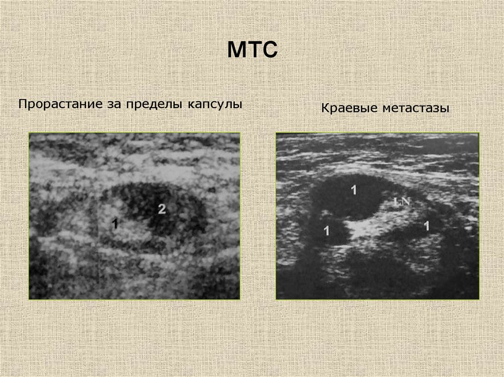 Метастазы в лимфоузлах прогноз