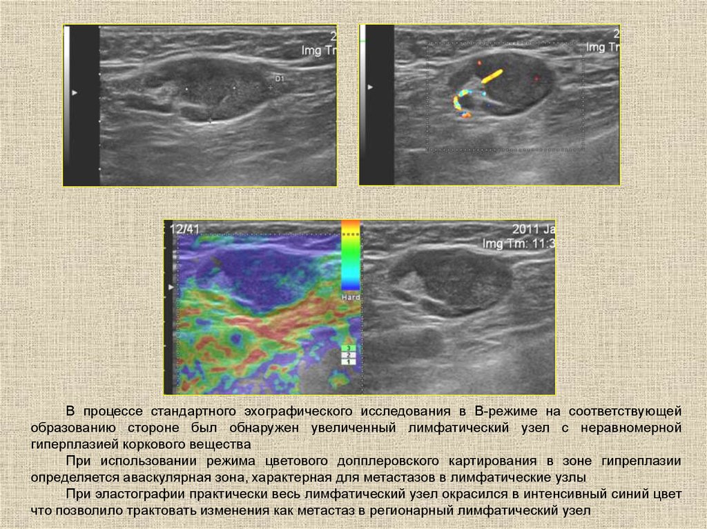 Метастаз в подмышечный лимфоузел. УЗИ анатомия лимфатических узлов. Строение лимфоузла на УЗИ норма. Строение лимфатического узла на УЗИ. УЗИ заушных лимфатических узлов.