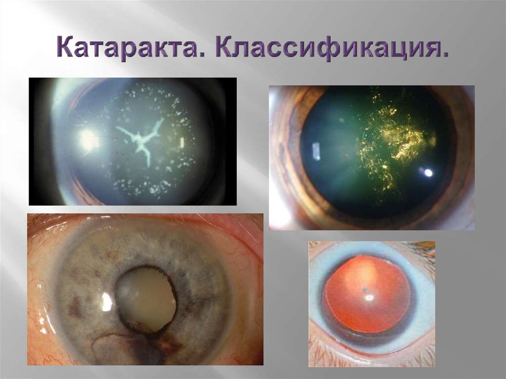 Начальная старческая катаракта. Кольцевидная катаракта Фоссиуса. Травматическая звездчатая катаракта. Классификация приобретенных катаракт.