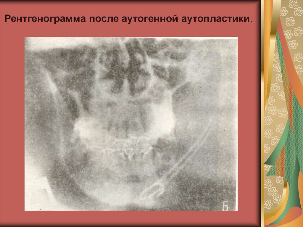 Неодонтогенные опухоли челюстей презентация