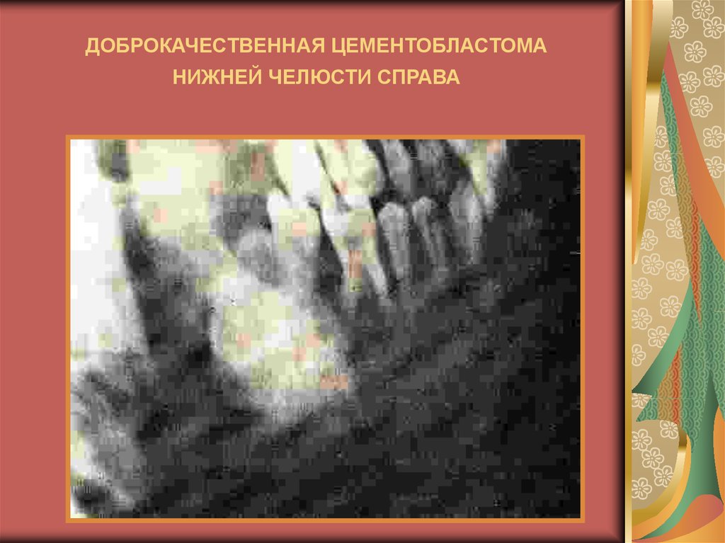 Доброкачественные одонтогенные опухоли презентация