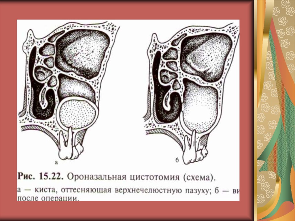 Цистотомия и цистэктомия