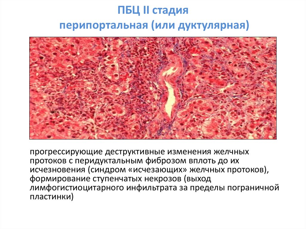 Билиарный цирроз печени презентация