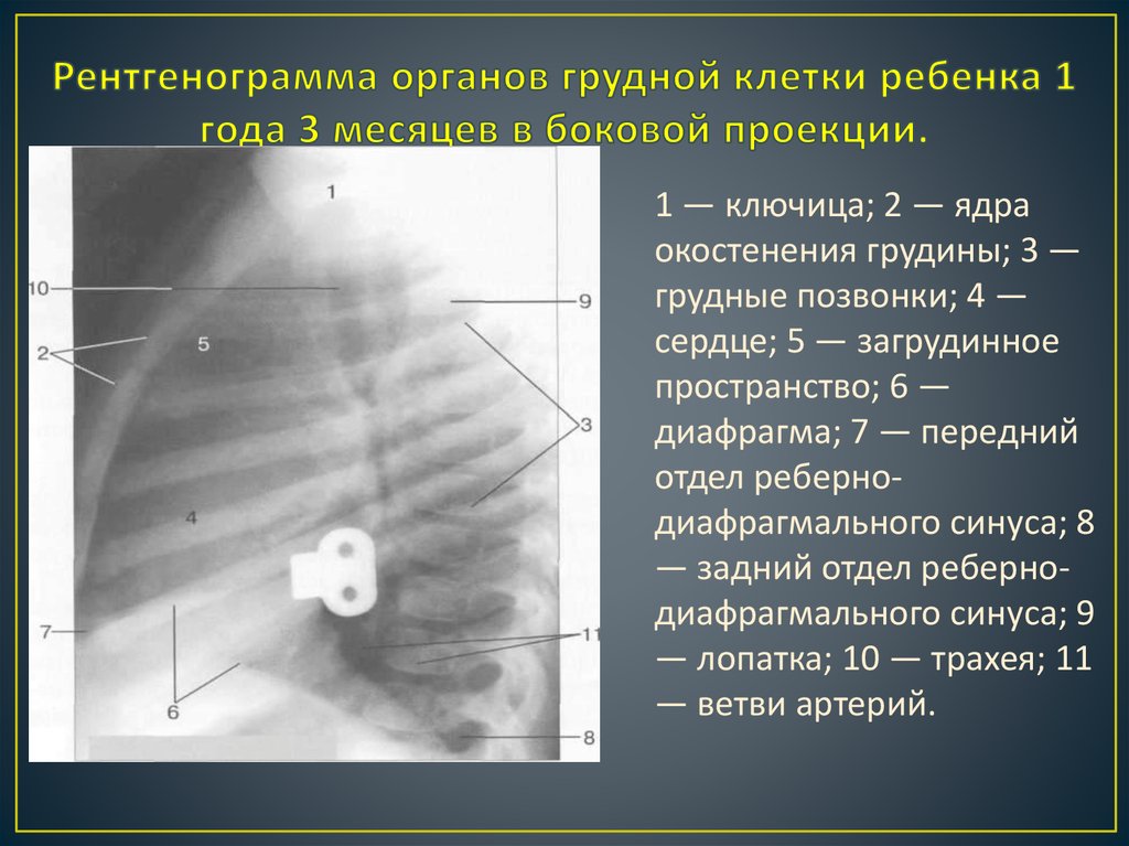 Рентгенограмма в боковой проекции. Рентгенограмма органов грудной клетки. На рентгенограмме органов грудной. Рентгенография грудины в боковой проекции. Боковая рентгенограмма органов грудной клетки.