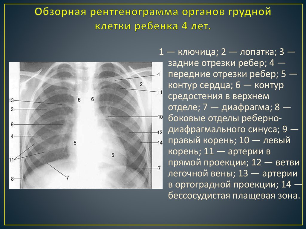 Изменения боковых отделов. Рентген грудной клетки боковая проекция. Рентген грудной клетки в боковой проекции норма. Обзорная рентгенограмма органов грудной клетки. Обзорная рентгенограмма грудной клетки.