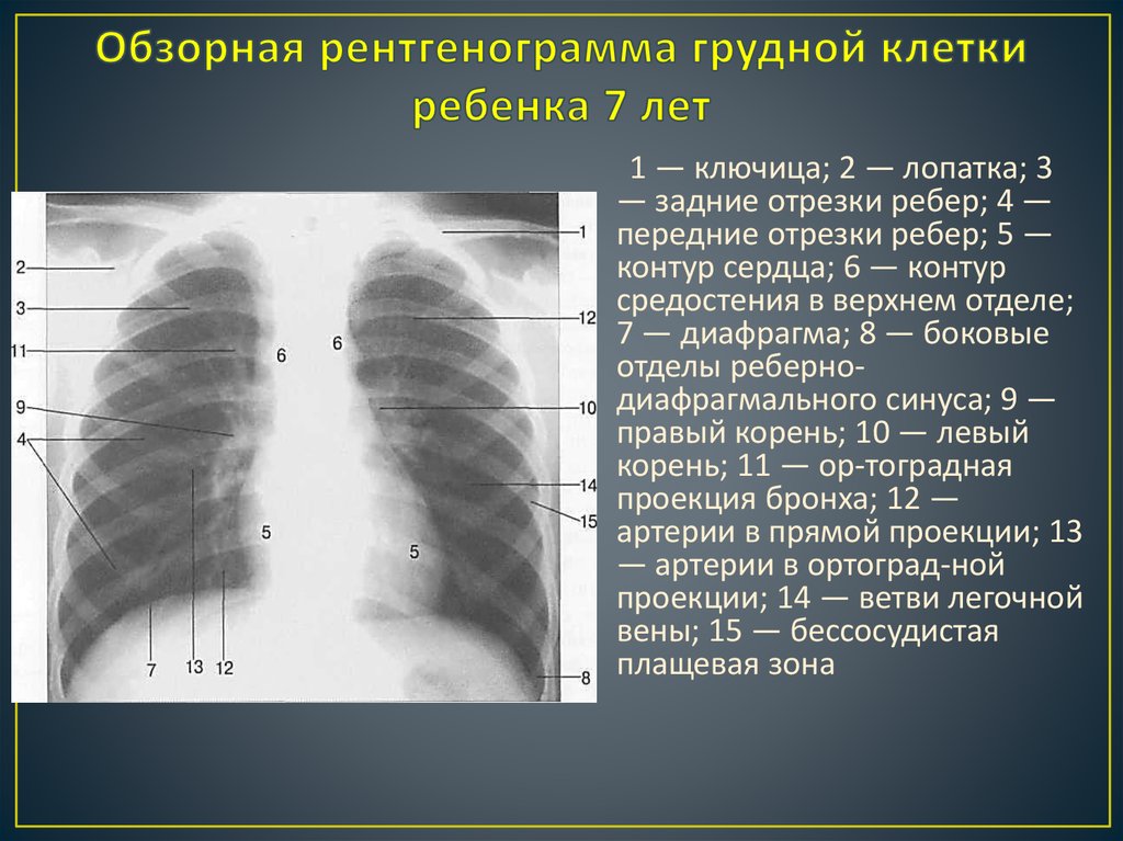 Фото нормальных легких на рентгене