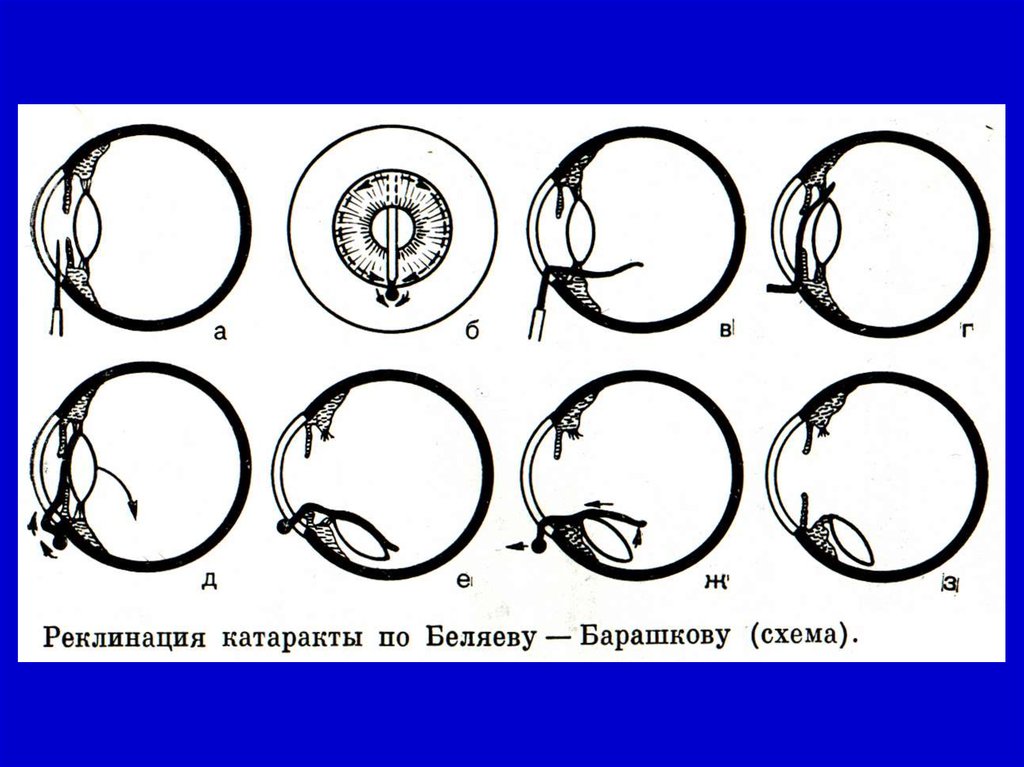 Катаракта схема