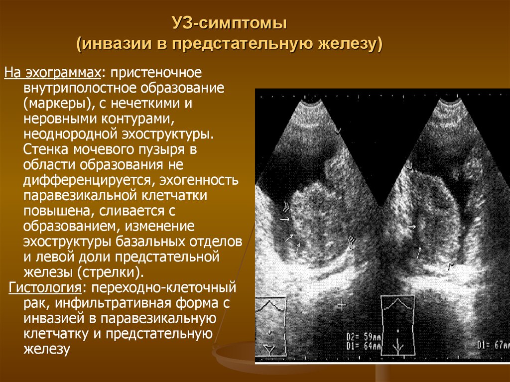 Контуры неровные нечеткие