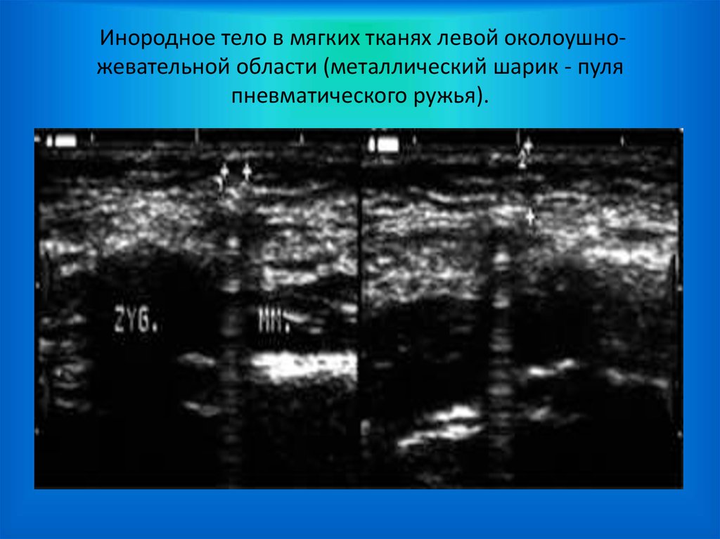 Ультразвуковая диагностика мягких тканей