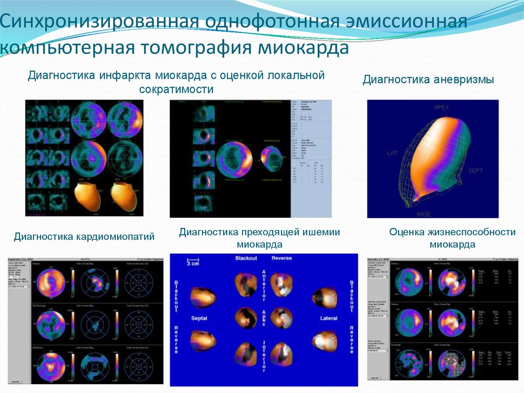 Что такое однофотонная эмиссионная компьютерная томография