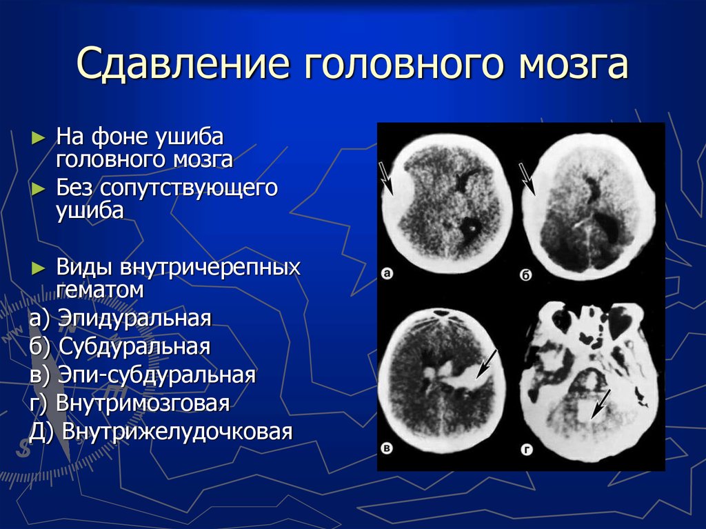 Сдавление мозга признаки. Сдавление головного мозга. Сдавление головного мозга внутричерепными гематомами. Сдавление головного мозга классификация. Симптомы сдавления черепа.