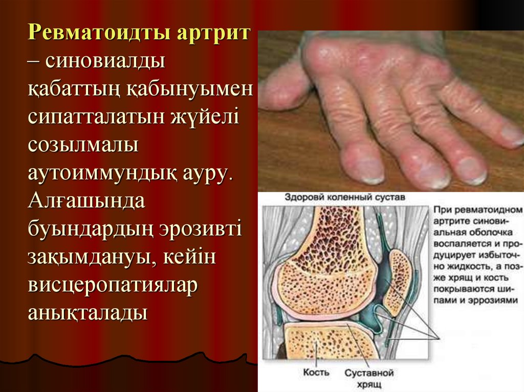 Ревматоидты артрит – синовиалды қабаттың қабынуымен сипатталатын жүйелі созылмалы аутоиммундық ауру. Алғашында буындардың эрозивті зақ