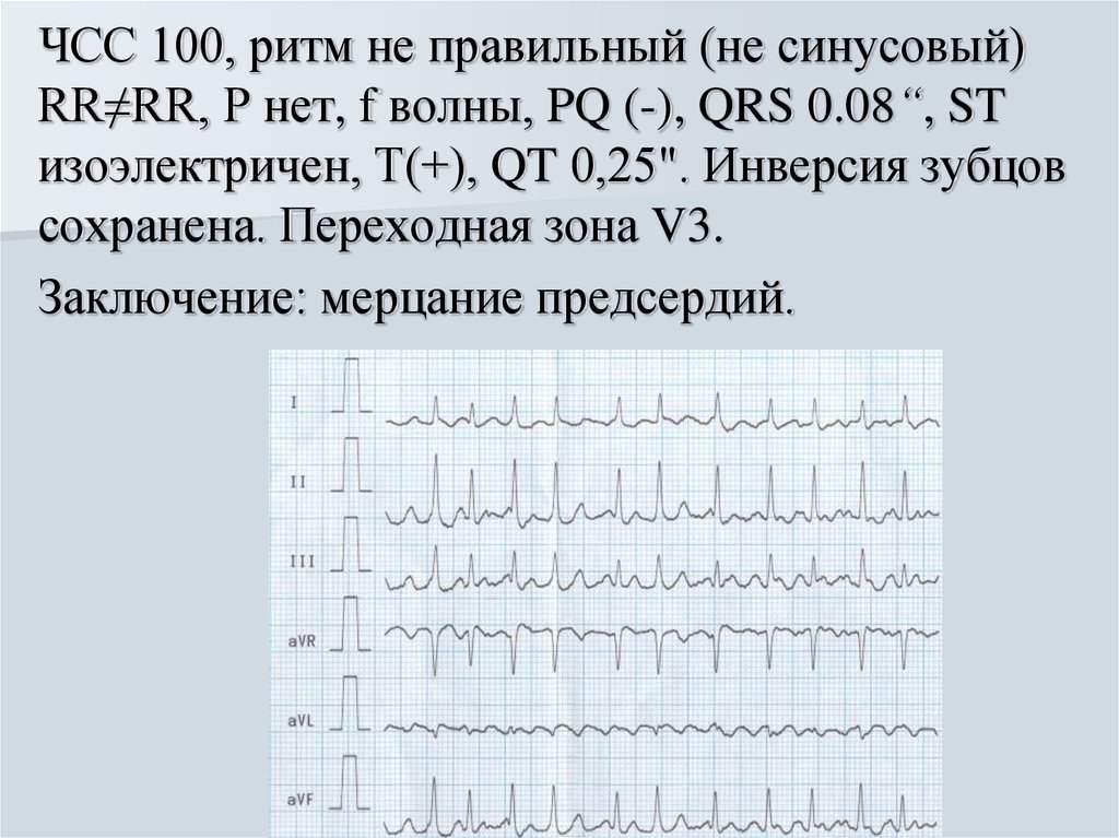 Что значит синусовый ритм сердца на экг. Синусовый и несинусовый ритм ЭКГ. Правильный синусовый ритм на ЭКГ. Ритм синусовый ЭКГ чсс73. Ритмы сердца на ЭКГ синусовый ритм.