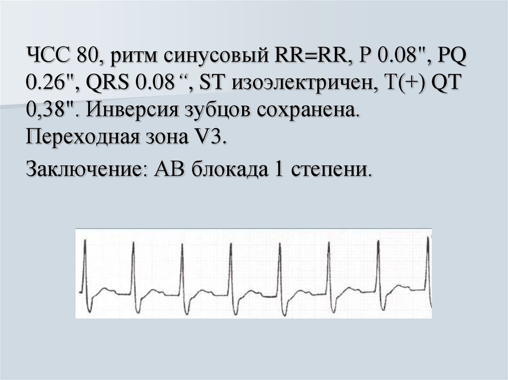 Синусовый ритм сердца. Заключение по ЭКГ ритм синусовая тахикардия. Синусовый ритм правильный ЧСС 85. Синусовый ритм 80. Синусовой ритм ЧСС 85 уд.