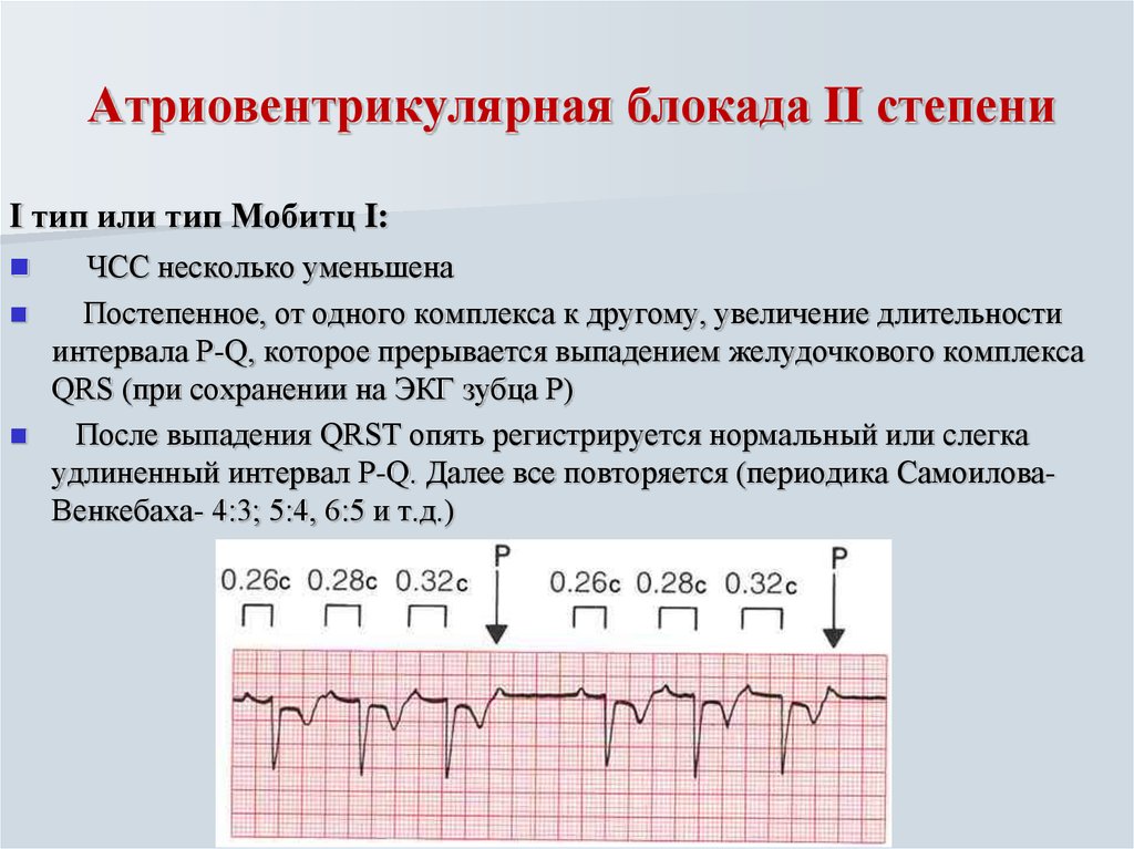 Увеличение интервала. Атриовентрикулярная блокада 2 степени типа Мобитц 1 характеризуется. ЭКГ атриовентрикулярная блокада II степени Мобитц 2. Атриовентрикулярные блокады 2 степени Тип II (Мобитц 2). Блокада атриовентрикулярной блокады ЭКГ.