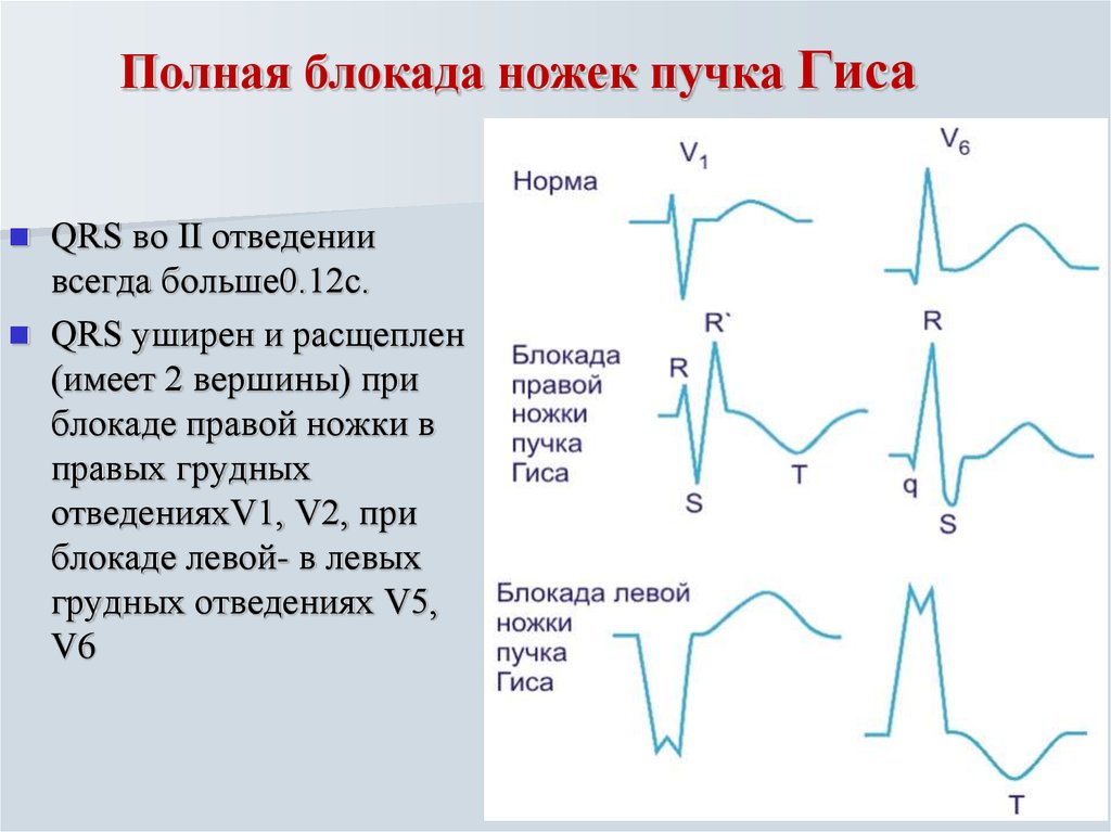 Полная блокада ножки. Признаки блокады правой ножки пучка Гиса на ЭКГ. ЭКГ при полной блокаде правой ножки пучка Гиса. Блокада правой ножки пучка Гиса на ЭКГ что это на ЭКГ. Блокада правой ножек пучка Гиса на ЭКГ.