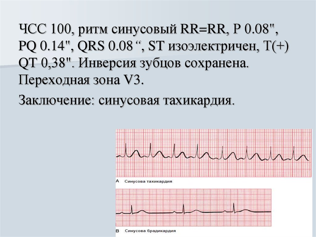 Синусовый ритм сердца. ЧСС 102 ритм синусовый. Синусовый ритм сердца с ЧСС 74. ЭКГ заключение синусовый. Регулярный синусовый ритм.