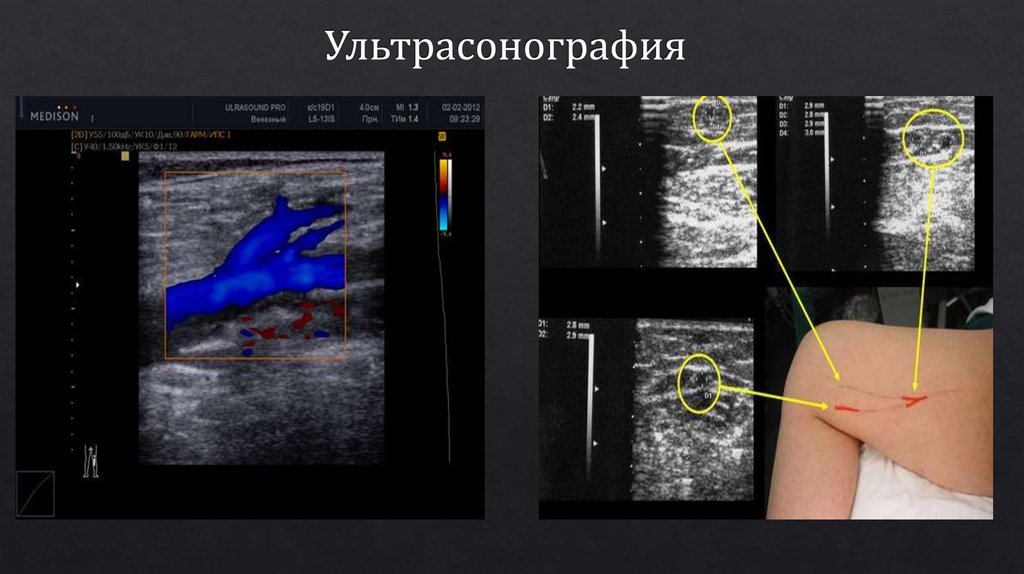 Ультрасонография