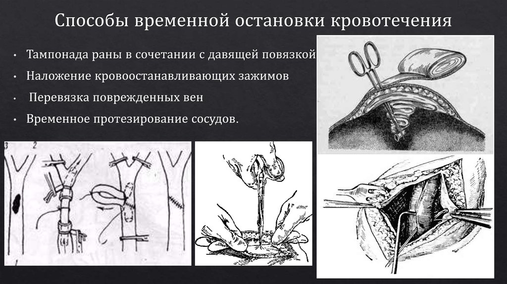 Способ временной. Хирургические методы остановки кровотечения. Способы остановки кровотечения у животных. Методы остановки кровотечения в ране.