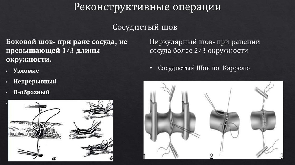 Шов артерий