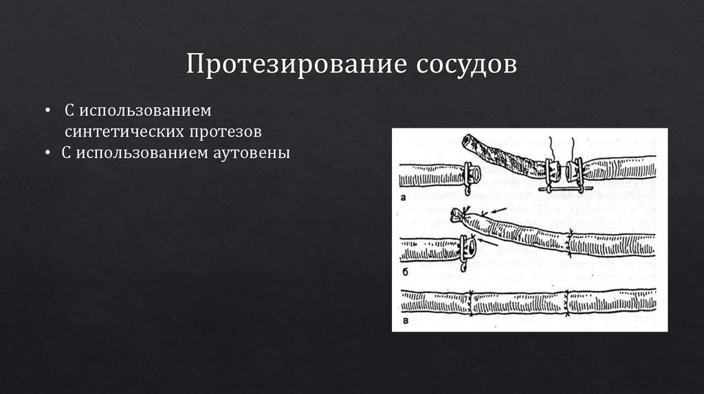 Протезирование сосудов презентация