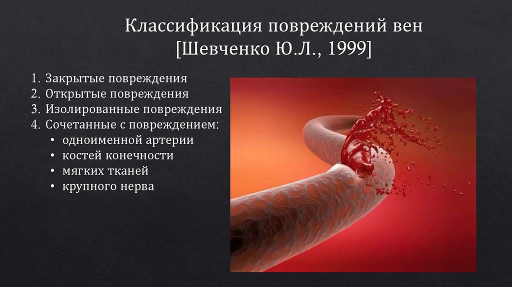 Классификация повреждений вен [Шевченко Ю.Л., 1999]