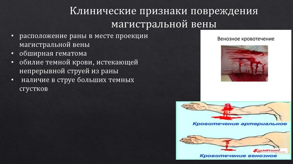 Клинические признаки повреждения магистральной вены
