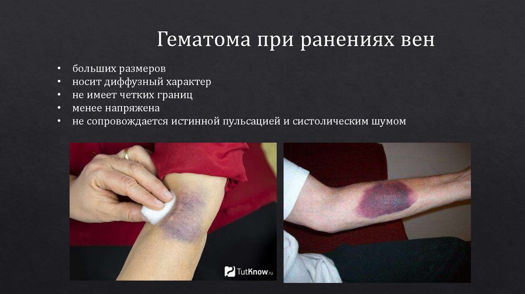 Гематома при ранениях вен